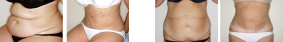Abdominoplastia_02