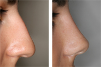 Rinoplastia_03