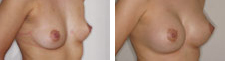Mamoplastia_03