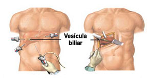 2 colelitiasis