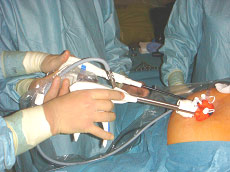 3 colelitiasis