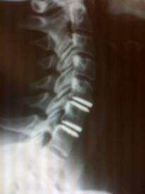 Hernia cervical 3