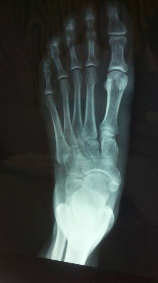 Osteonecrosis
