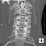TC Columna cervical