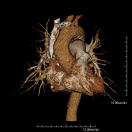 Angio-TC Arterias pulmonares