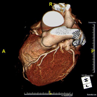 Angio-TC Cardíaco o TC Cardíaco