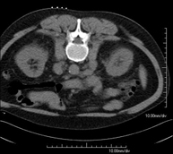 PAAF (Punción) Abdominal guiada por TC
