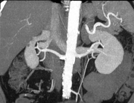 Angio-TC Arterias renales