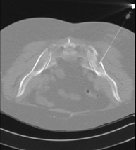 Biopsia ósea guiada por TC