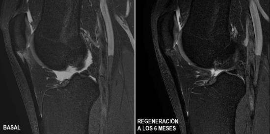 Tendón Rotuliano Ensayo Clinico AJSM 2
