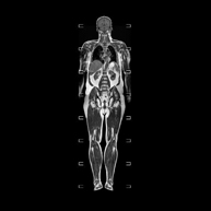 RM Cuerpo entero (Total body)