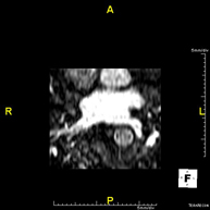 Angio-RM venas pulmonares
