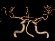 Angio-RM intracraneal