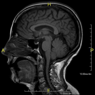 RM Cerebral