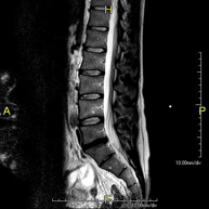 RM Columna lumbar