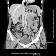 TC Abdominopélvico