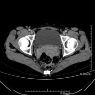 TC Pelvis