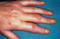 Qué diferencias hay entre artritis y artrosis