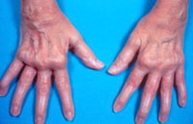 Qué síntomas produce la artritis