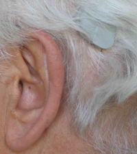 implante de oído medio