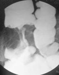 Radiografía de una tumoración en el intestino grueso