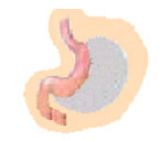 Gastrectomía tubular