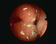 Adenoidectomía2