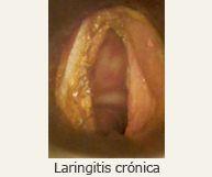 Laringitis crónica
