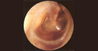 Secreción del oído medio