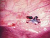 Endometrosis-4
