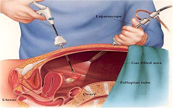 Endometrosis - diagnóstico