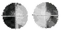 Hemianopsia bitemporal