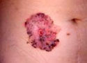 Carcinoma tronco
