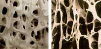 Osteoporosis