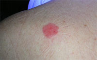 Carcinoma escamoso (enfermedad de Bowen)