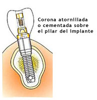 implantes_11