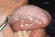 Úlcera lingual