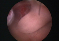Pólipo (histeroscopia)