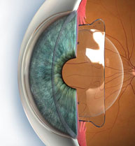 Cirugía refractiva ocular