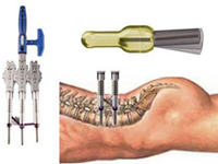 Implantes flexibles dinámicos percutáneos insertados a través de un tubo con incisión de sólo 12 mm