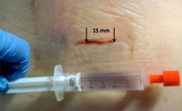 Incisión post-quirúrgica de 15 mm