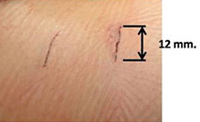 doble fusión intervertebral con caja de PEEK con incisiones de solo 12 mm y bajo anestesia local