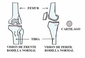 Artrosis-protesis 3