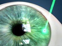 Iridotomia Laser Yag Laser Ocular