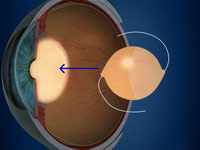 Posición de la lente intraocular