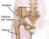 Artroscopia cadera
