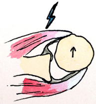 Figura 4. Subluxación de hombro