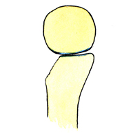 Figura 8. Perdida ósea margen glenoideo anterior (Zona izquierda