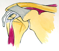 Figura 9. Rotura tendinosa