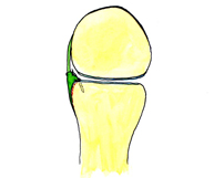 Figura 11. Reparacion de Bankart. Tornillo anclado en glenoides anterior e hilos reanclando el labrum (color verde)